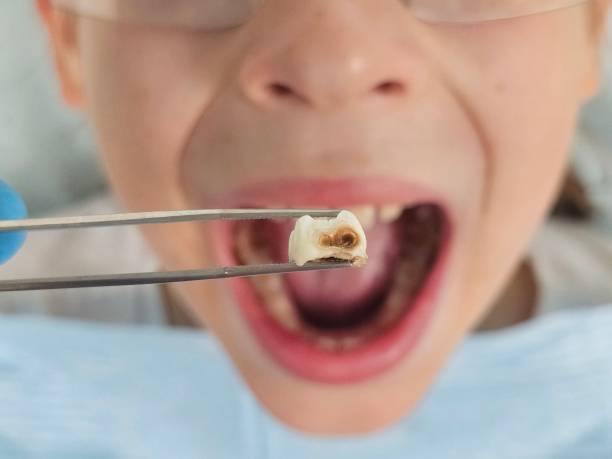Best Emergency Treatment for Toothache in The Pinery, CO